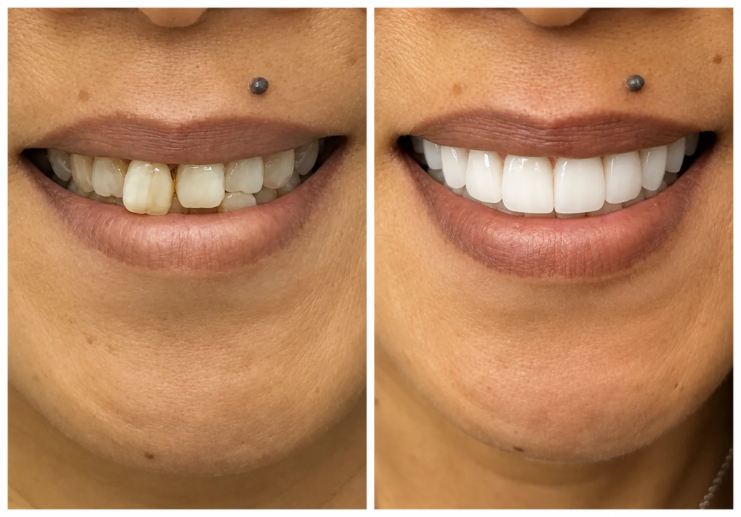Close-up smile before and after single tooth shade matching